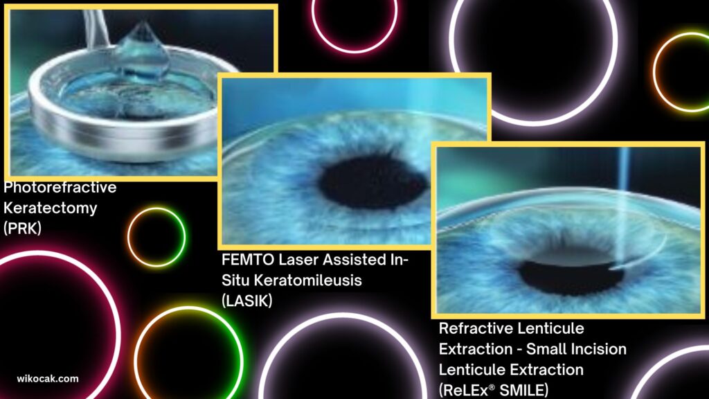 Jenis Laser Vision Correction